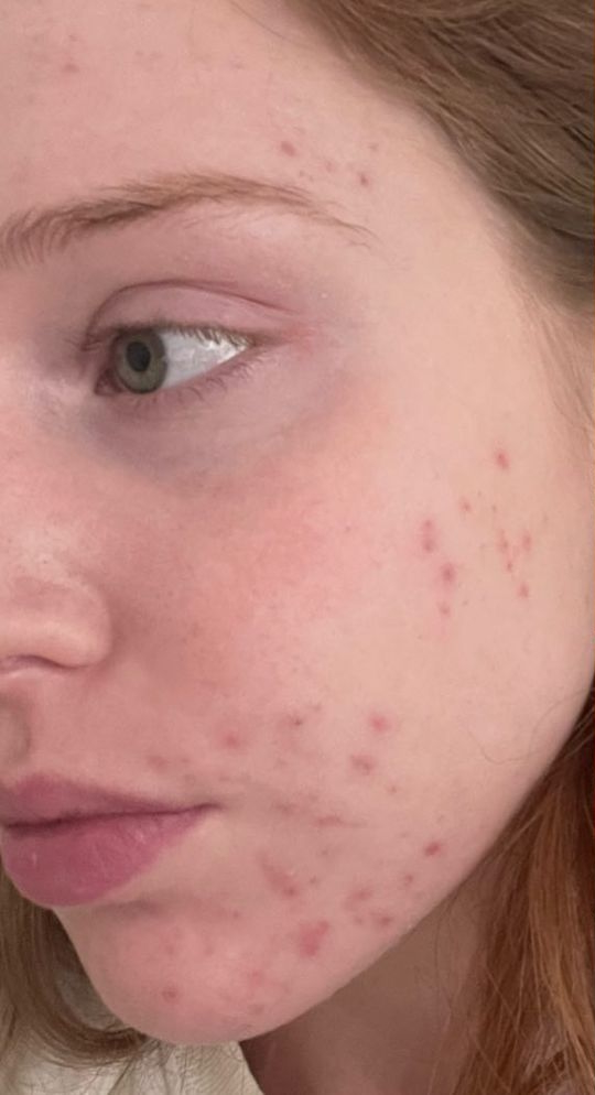 Peau avec imperfections et texture irrégulière avant Hydrafacial