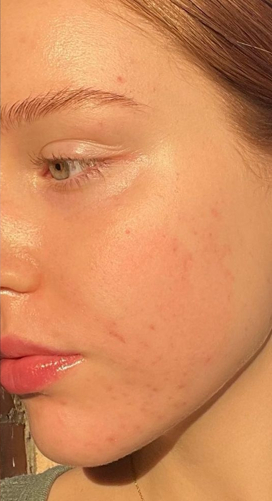 Peau lissée et unifiée après 2 séances Hydrafacial Deluxe