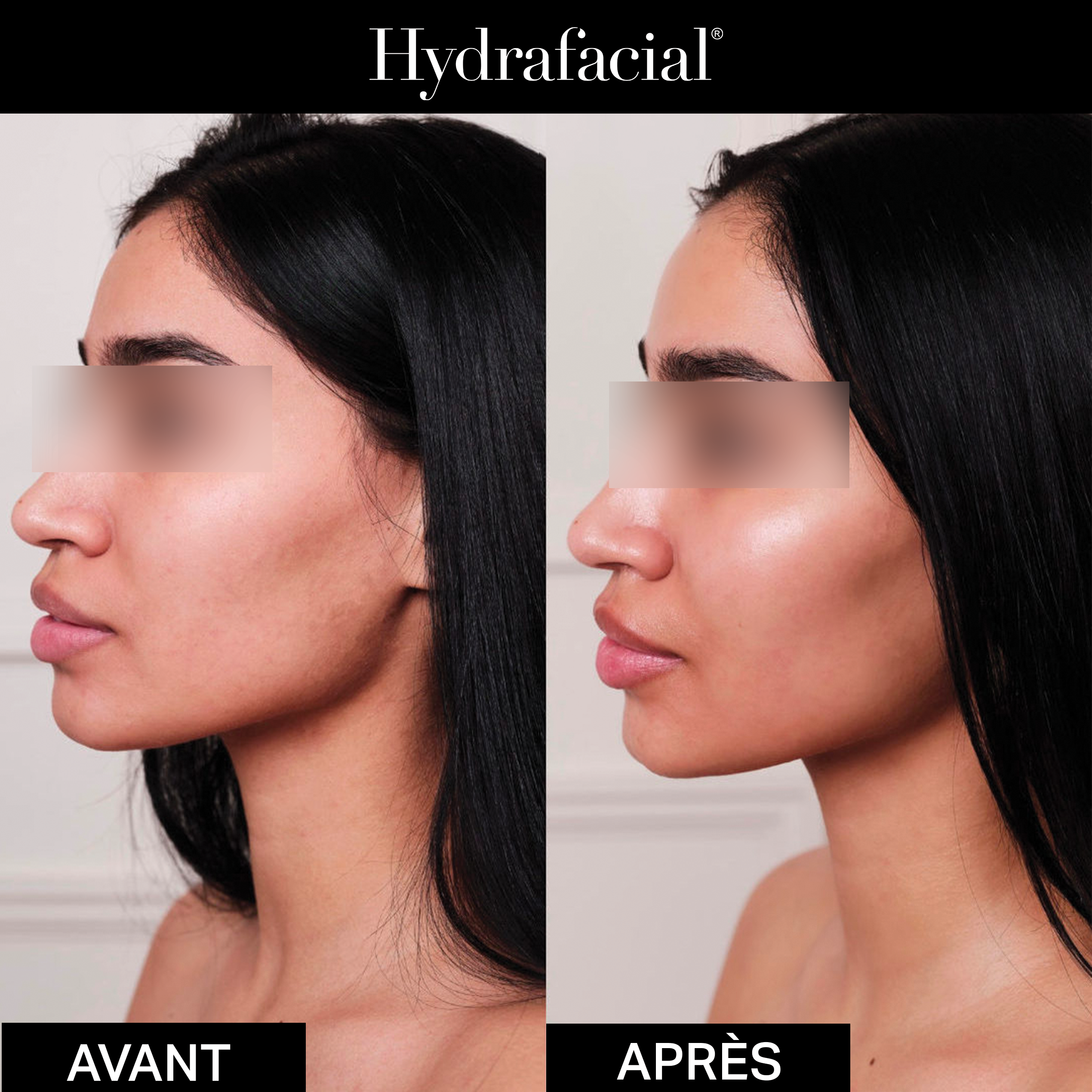 Résultat avant et après un soin Hydrafacial Signature chez MAS-K-RAD Marseille